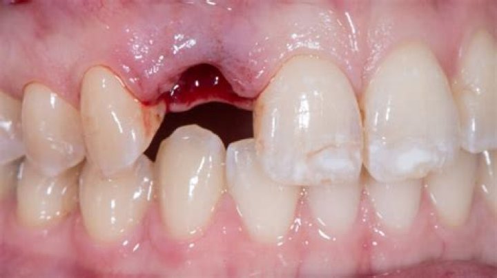 Can a loose tooth tighten back up?