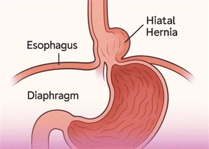 Can a sliding hiatus hernia become strangulated?