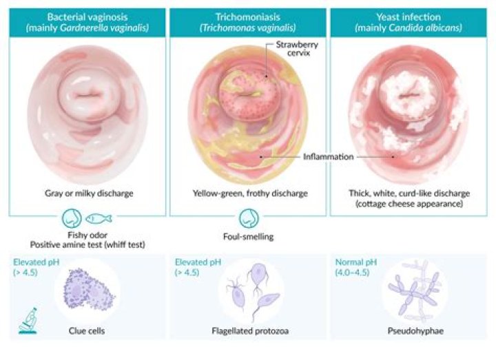 Can I test myself for trichomoniasis?