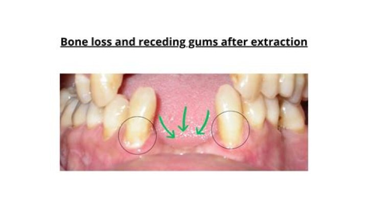 Do bone fragments in gum need to be removed?
