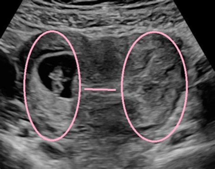 Does a tilted uterus affect conception?