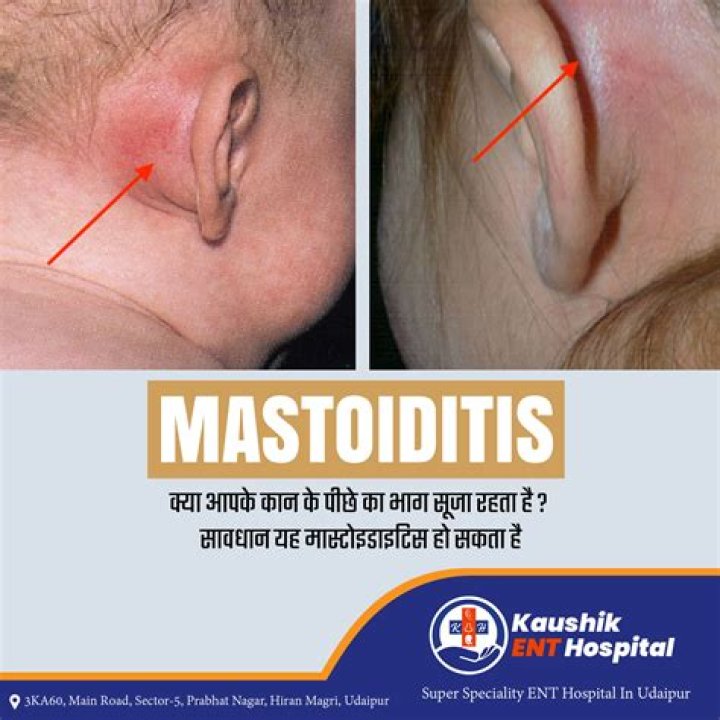 Does mastoiditis come on suddenly?