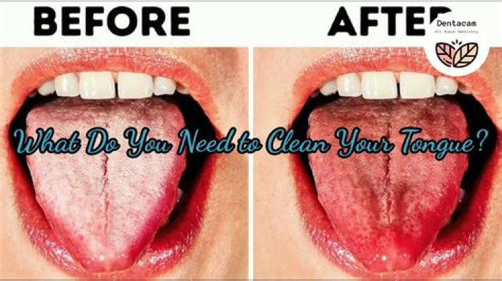 How do I get rid of my toddlers white tongue?