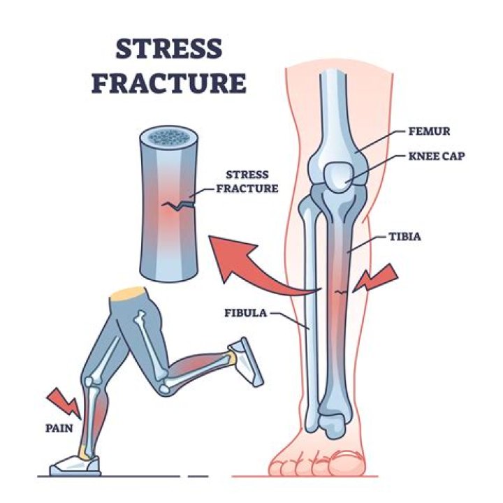 How do you know if you have a stress fracture in your back?