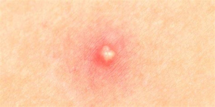 How do you treat an infected pimple?
