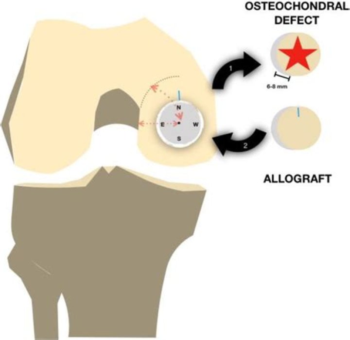 How long do osteochondral allografts last?
