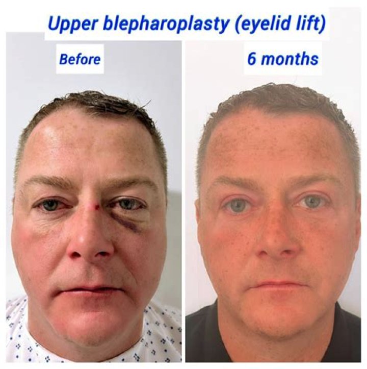 How long does it take for eyes to heal after eyelid surgery?