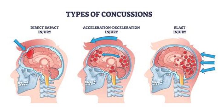 How many concussions did Scott Ross have?