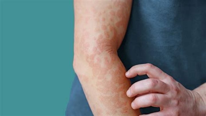 Is angioedema same as urticaria?
