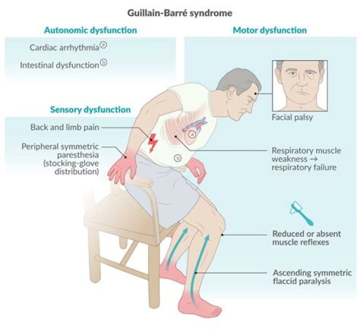 Is Guillain Barre ascending or descending?