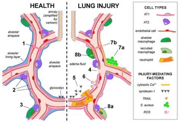 What are the top 5 lung diseases?