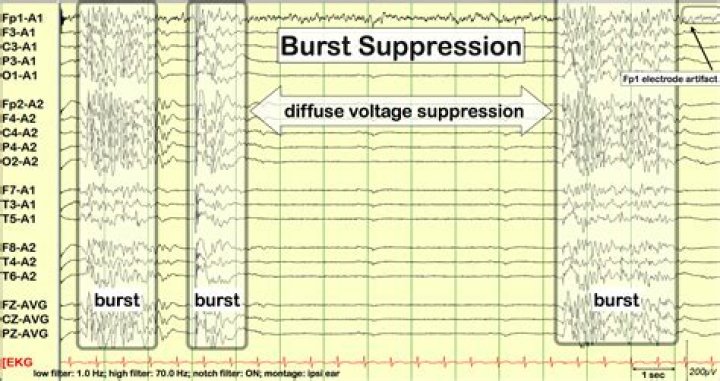 What can cause a burst suppression pattern?