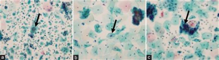 What does follicular lesion of undetermined significance mean?