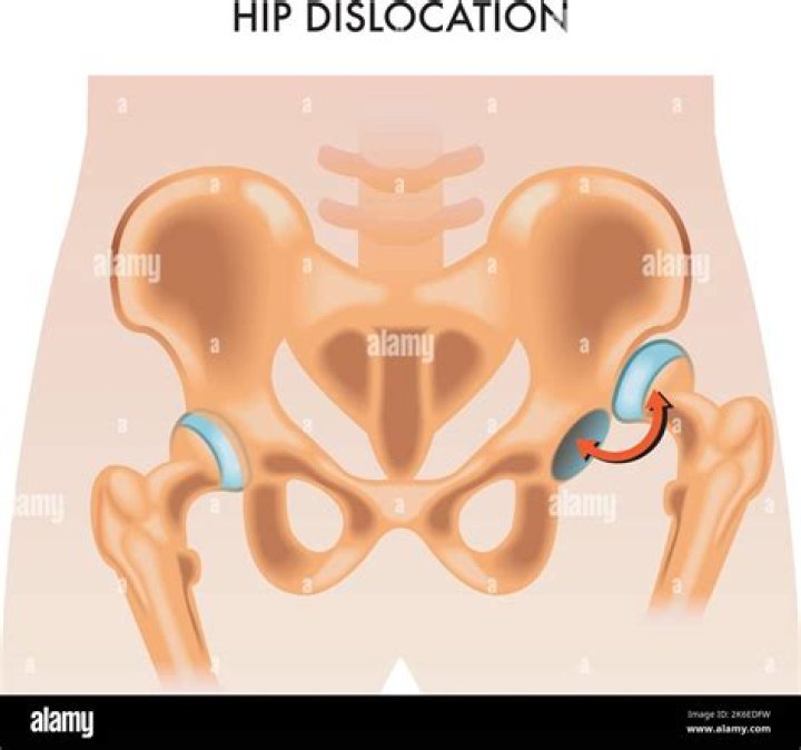 What does it mean to reduce a hip dislocation?