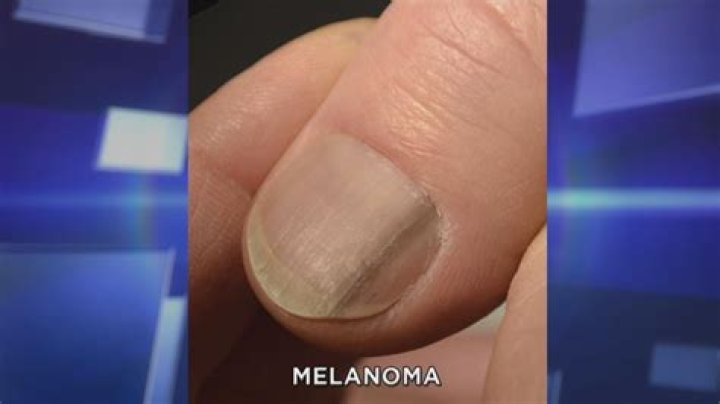 What does melanoma of the nail bed look like?