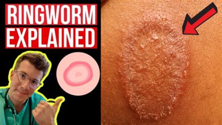 What does ring worms look like?