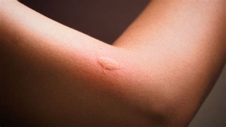 What insect bite causes large swelling?