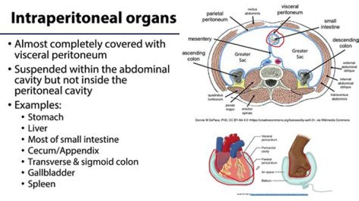 What is a Subperitoneal fibroid?
