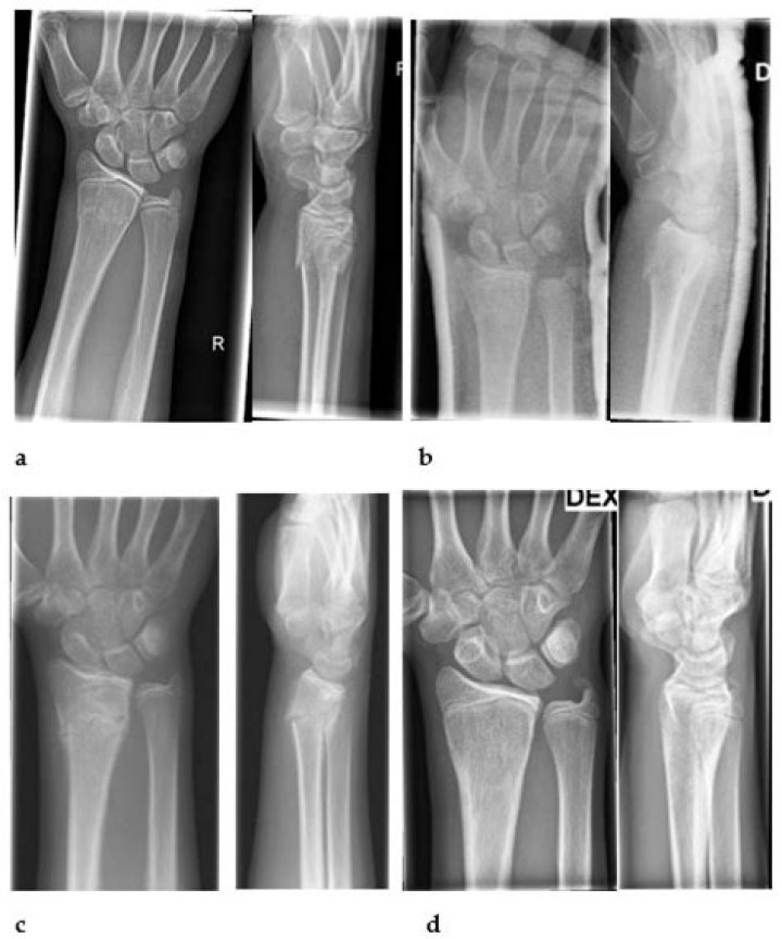 What is distal proctitis?