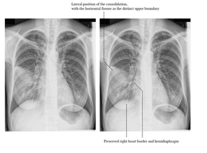 What is patchy opacity in lung means?