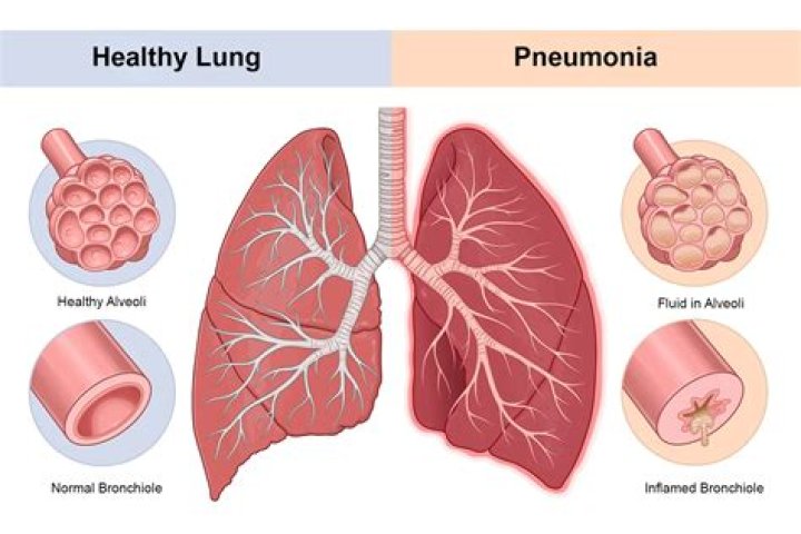 What should you not do when you have pneumonia?