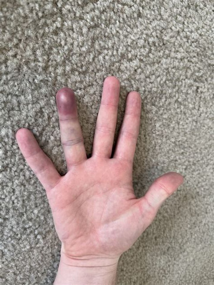 When should I be worried about a smashed thumb?