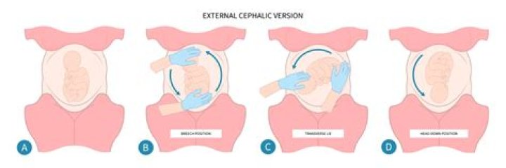Where do you feel kicks if baby is transverse?