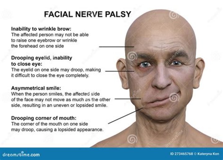 Why does the right side of my face droop?